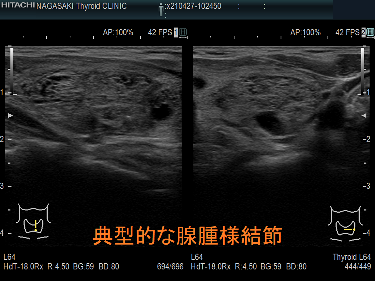 典型的な腺腫様結節 超音波(エコー)画像 典型的な腺腫様結節 超音波(エコー)画像