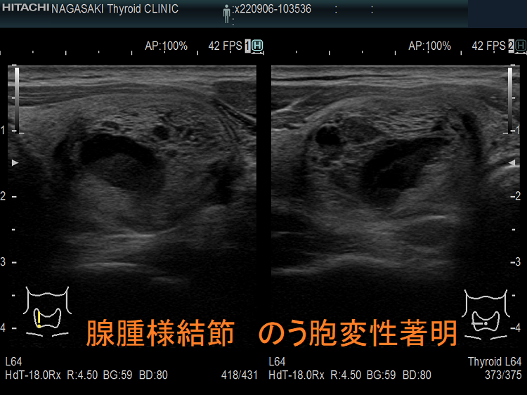 腺腫様結節(のう胞変性著明)超音波(エコー)画像 腺腫様結節(のう胞変性著明)超音波(エコー)画像