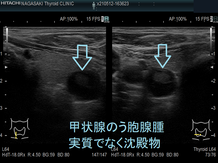 甲状腺のう胞腺腫 実質でなく沈殿物 甲状腺のう胞腺腫 実質でなく沈殿物