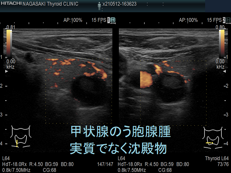甲状腺のう胞腺腫 実質でなく沈殿物 ドプラーモード 甲状腺のう胞腺腫 実質でなく沈殿物 ドプラーモード