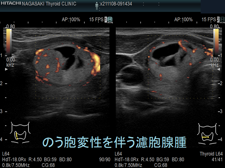 のう胞変性を伴う濾胞腺腫 超音波(エコー)画像 ドプラーモード のう胞変性を伴う濾胞腺腫 超音波(エコー)画像 ドプラーモード