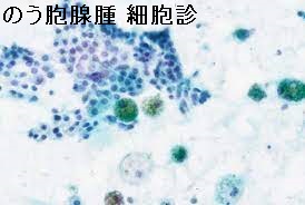 甲状腺のう胞腺腫 細胞診 甲状腺のう胞腺腫 細胞診