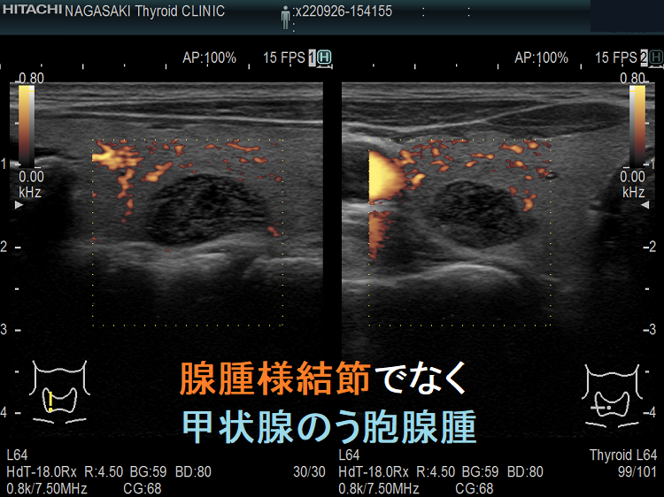 腺腫様結節でなく甲状腺のう胞腺腫 超音波(エコー)画像 腺腫様結節でなく甲状腺のう胞腺腫 超音波(エコー)画像