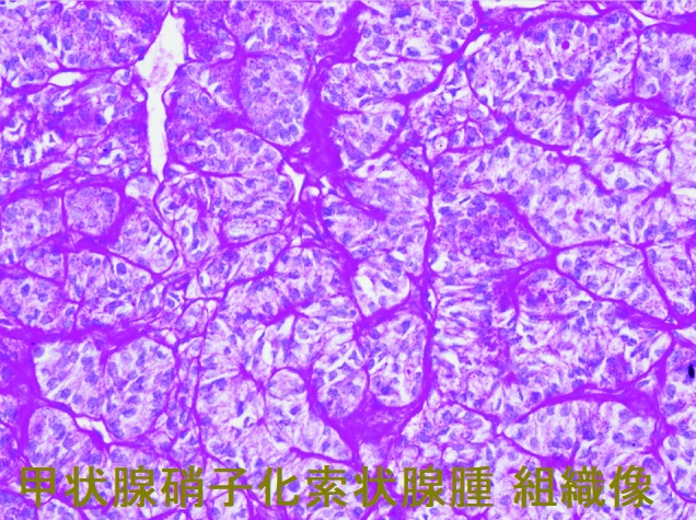甲状腺硝子化索状腺腫 組織像 甲状腺硝子化索状腺腫 組織像