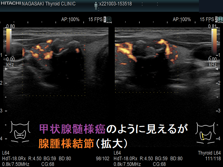 甲状腺髄様癌のように見えるが腺腫様結節(拡大)2 甲状腺髄様癌のように見えるが腺腫様結節(拡大)