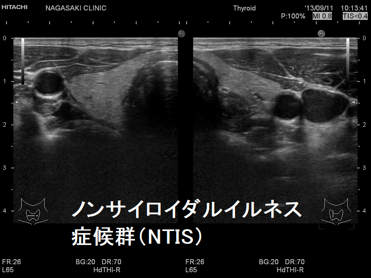 ノンサイロイダルイルネス症候群(NTIS) ノンサイロイダルイルネス症候群(NTIS)
