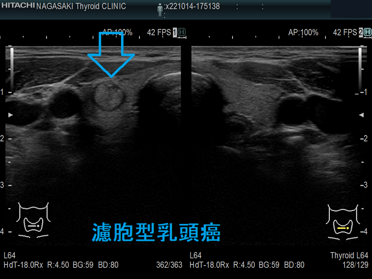 濾胞型乳頭癌(FVPTC) 濾胞型乳頭癌(FVPTC)
