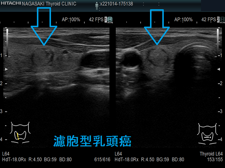 濾胞型乳頭癌(FVPTC)2 濾胞型乳頭癌(FVPTC)2