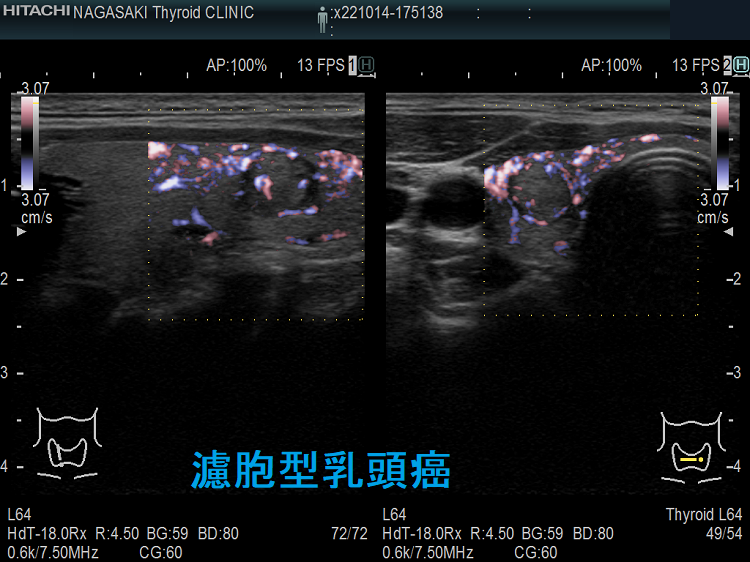 濾胞型乳頭癌(FVPTC) ドプラーモード 濾胞型乳頭癌(FVPTC) ドプラーモード