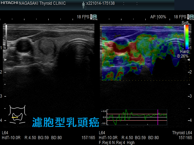 濾胞型乳頭癌(FVPTC) エラストグラフィー 濾胞型乳頭癌(FVPTC) エラストグラフィー