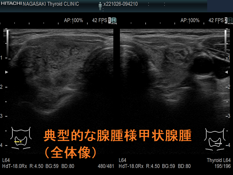 典型的な腺腫様甲状腺腫(全体像) 典型的な腺腫様甲状腺腫(全体像)