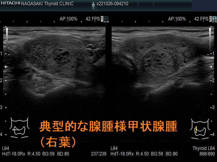 典型的な腺腫様甲状腺腫(右葉) 典型的な腺腫様甲状腺腫(右葉)