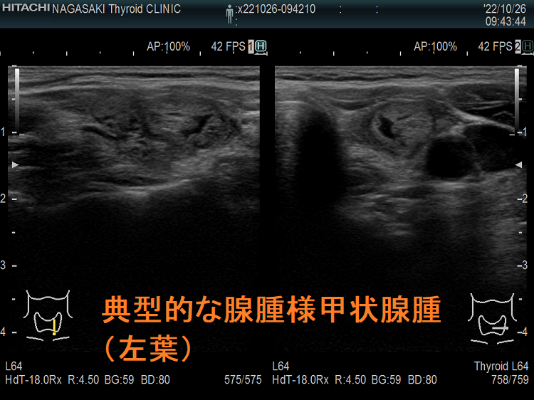 典型的な腺腫様甲状腺腫(左葉) 典型的な腺腫様甲状腺腫(左葉)