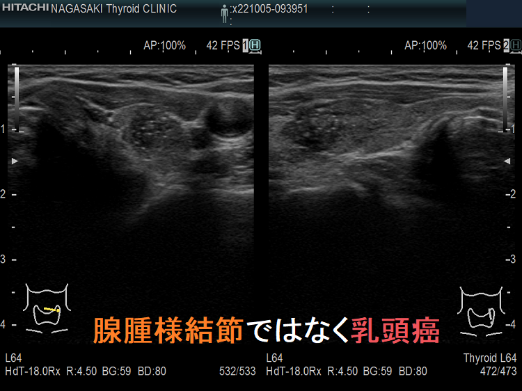 腺腫様結節ではなく甲状腺乳頭癌 腺腫様結節ではなく甲状腺乳頭癌