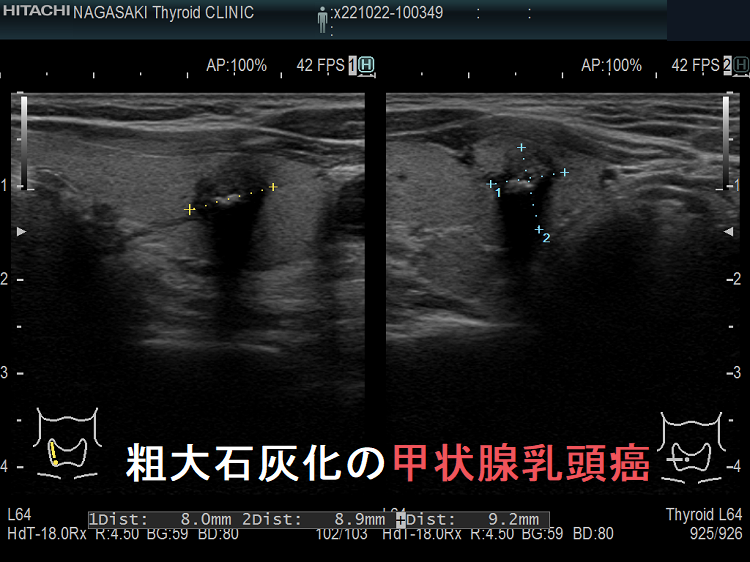 粗大石灰化の甲状腺乳頭癌 粗大石灰化の甲状腺乳頭癌