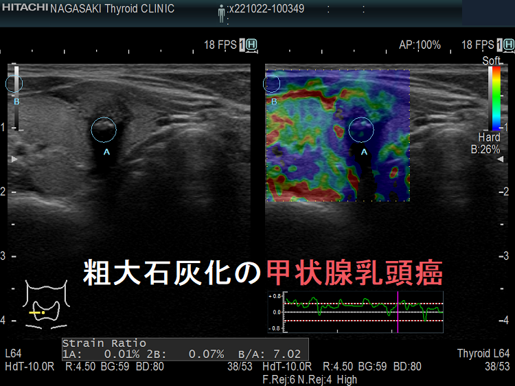 粗大石灰化の甲状腺乳頭癌 エラストグラフィー 粗大石灰化の甲状腺乳頭癌 エラストグラフィー