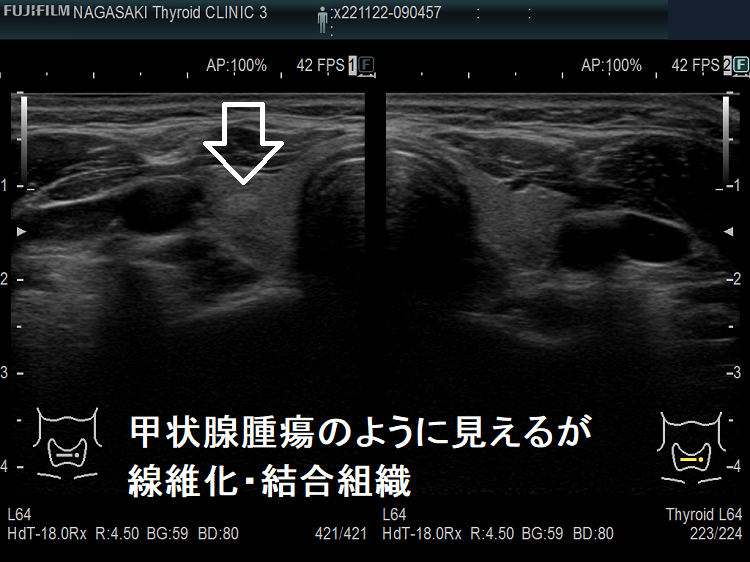 甲状腺腫瘍のように見えるが、線維化・結合組織 超音波(エコー)画像 甲状腺腫瘍のように見えるが、線維化・結合組織 超音波(エコー)画像