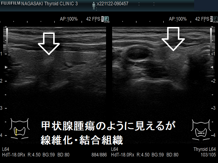 甲状腺腫瘍のように見えるが、線維化・結合組織 超音波(エコー)画像2 甲状腺腫瘍のように見えるが、線維化・結合組織 超音波(エコー)画像2