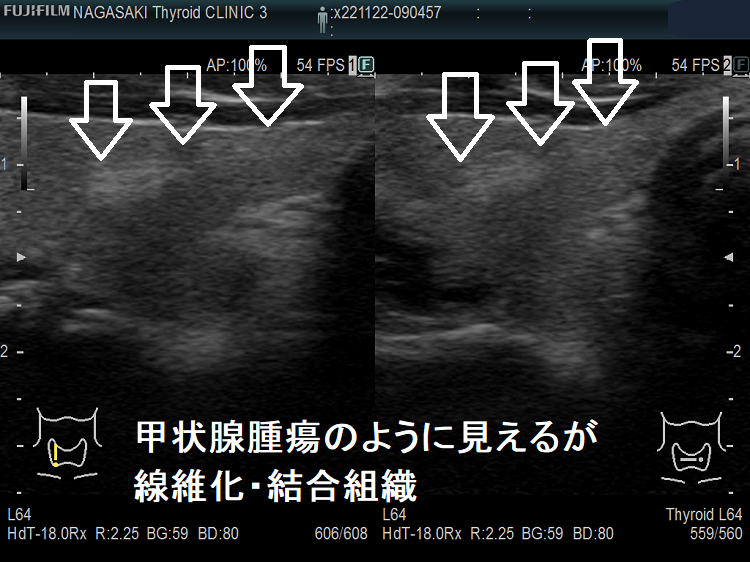 甲状腺腫瘍のように見えるが線維化・結合組織 超音波(エコー)画像 拡大 甲状腺腫瘍のように見えるが線維化・結合組織 超音波(エコー)画像 拡大