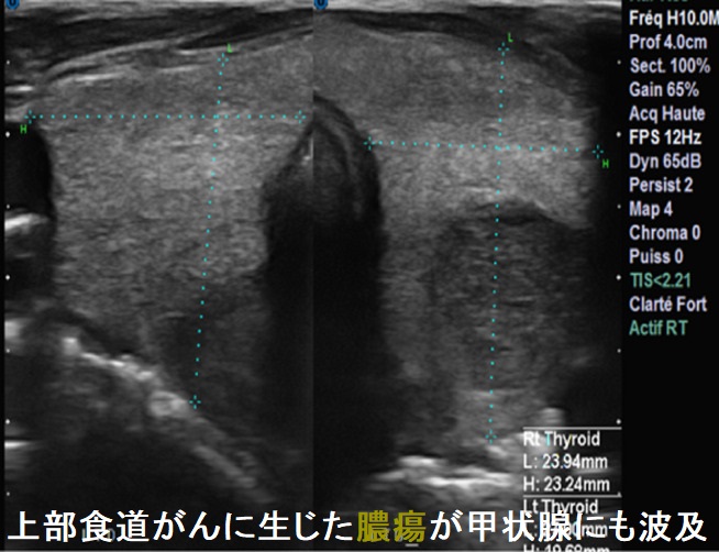 上部食道がんに生じた膿瘍が甲状腺にも波及1 上部食道がんに生じた膿瘍が甲状腺にも波及1