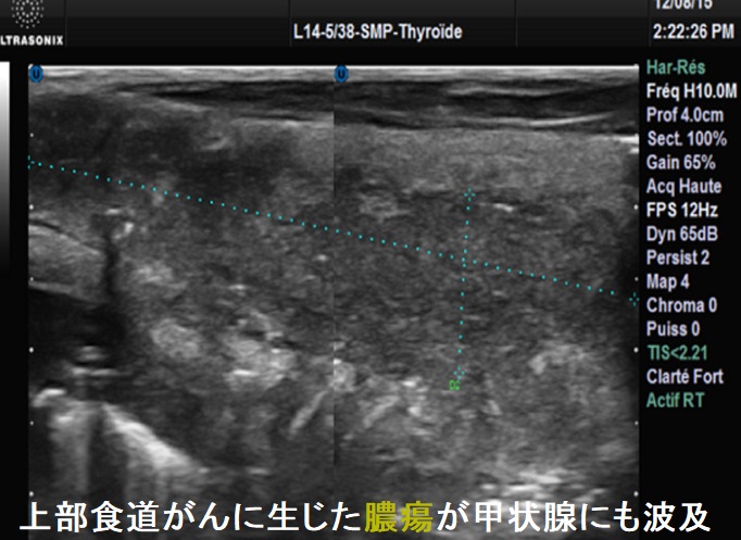 上部食道がんに生じた膿瘍が甲状腺にも波及2 上部食道がんに生じた膿瘍が甲状腺にも波及2