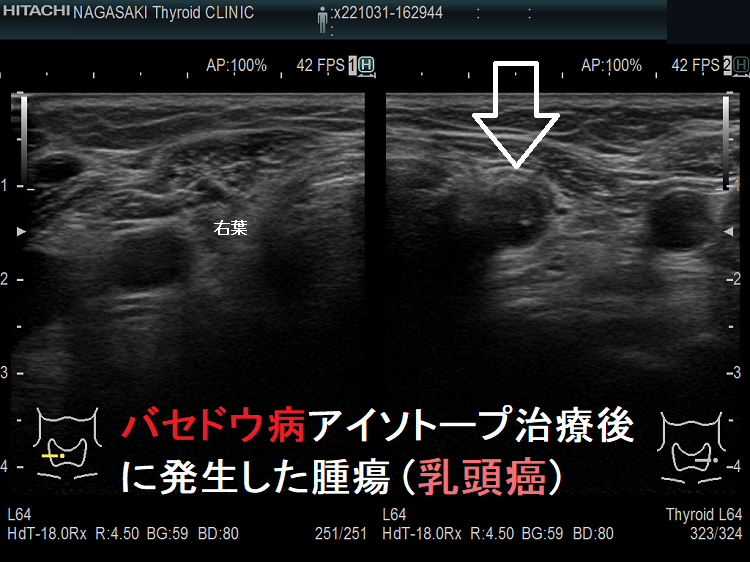 バセドウ病アイソトープ治療後に発生した甲状腺腫瘍(甲状腺乳頭癌) バセドウ病アイソトープ治療後に発生した甲状腺腫瘍(甲状腺乳頭癌)