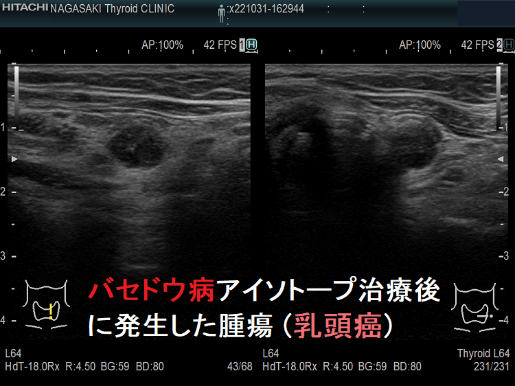バセドウ病アイソトープ治療後に発生した甲状腺腫瘍(甲状腺乳頭癌)2 バセドウ病アイソトープ治療後に発生した甲状腺腫瘍(甲状腺乳頭癌)2