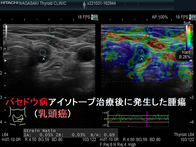 バセドウ病アイソトープ治療後に発生した腫瘍(乳頭癌) エラストグラフィー バセドウ病アイソトープ治療後に発生した腫瘍(乳頭癌) エラストグラフィー