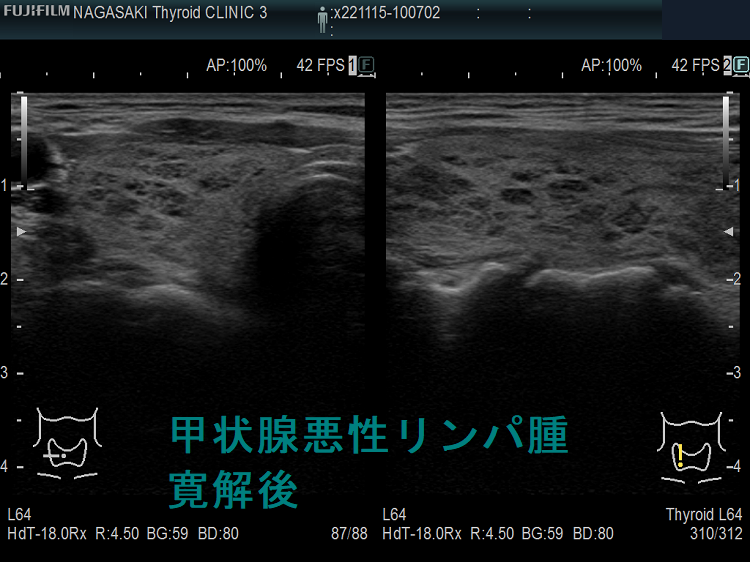 甲状腺悪性リンパ腫 寛解後 超音波(エコー)画像 甲状腺悪性リンパ腫 寛解後 超音波(エコー)画像