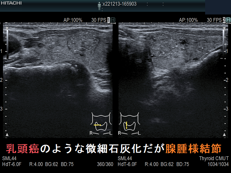 甲状腺乳頭癌のような微細石灰化だが腺腫様結節 甲状腺乳頭癌のような微細石灰化だが腺腫様結節
