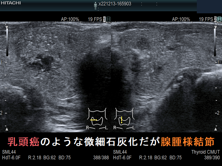 甲状腺乳頭癌のような微細石灰化だが腺腫様結節(拡大) 甲状腺乳頭癌のような微細石灰化だが腺腫様結節(拡大)