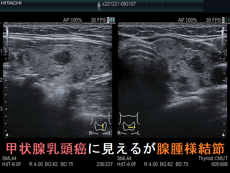 甲状腺乳頭癌に見えるが腺腫様結節 甲状腺乳頭癌に見えるが腺腫様結節