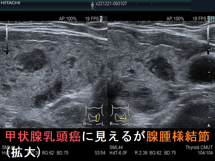 甲状腺乳頭癌に見えるが腺腫様結節(拡大) 甲状腺乳頭癌に見えるが腺腫様結節(拡大)