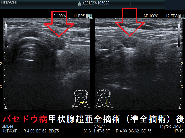バセドウ病甲状腺超亜全摘術(準全摘術)後 超音波(エコー)画像 バセドウ病甲状腺超亜全摘術(準全摘術)後 超音波(エコー)画像