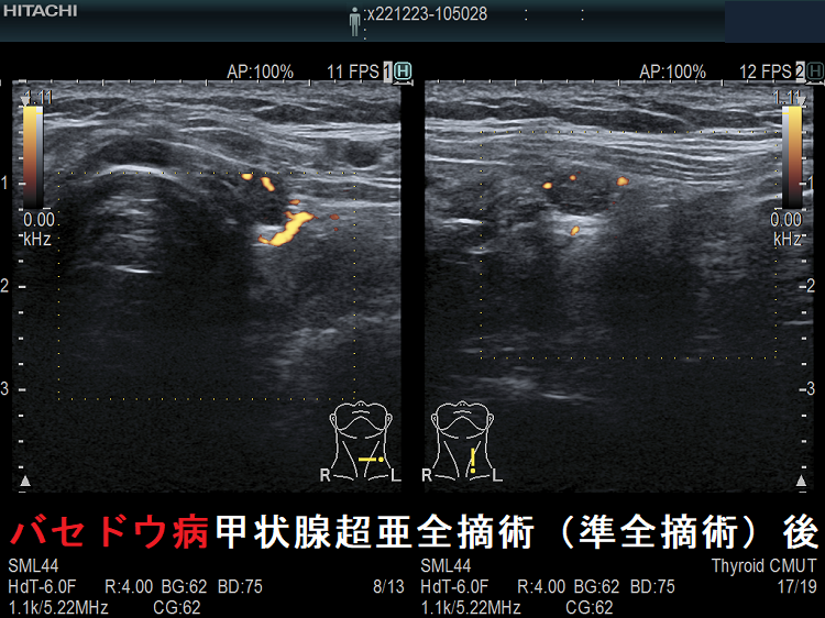 バセドウ病甲状腺超亜全摘術(準全摘術)後 超音波(エコー)画像 ドプラーモード バセドウ病甲状腺超亜全摘術(準全摘術)後 超音波(エコー)画像 ドプラーモード
