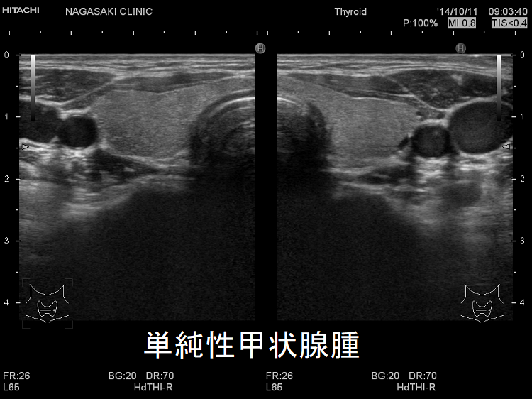 単純性甲状腺腫 単純性甲状腺腫