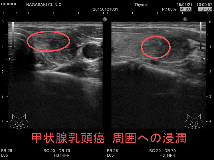 甲状腺乳頭癌 周囲への浸潤 甲状腺乳頭癌 周囲への浸潤