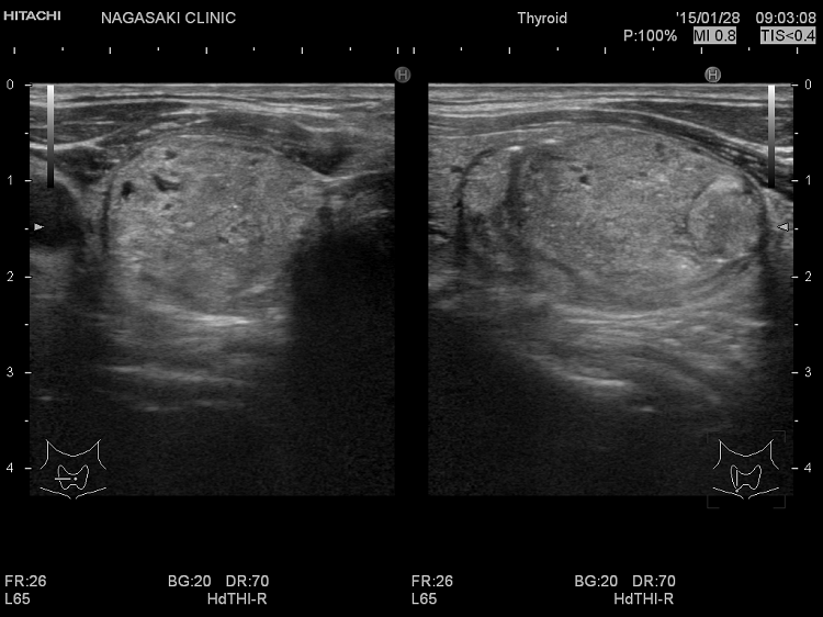 超音波(エコー)検査での腺腫様甲状腺腫・腺腫様結節と甲状腺乳頭