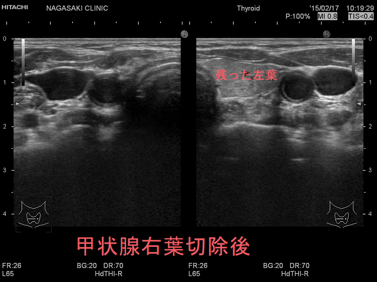 甲状腺右葉切除後 甲状腺右葉切除後