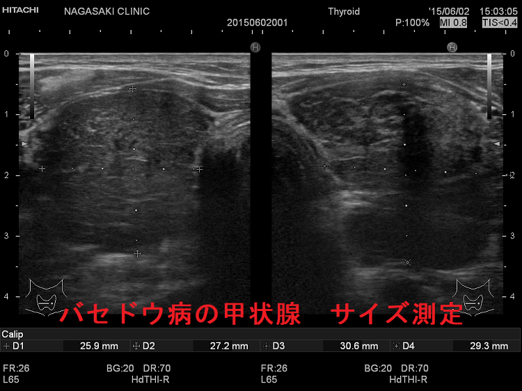 バセドウ病の甲状腺 サイズ測定(水平断) バセドウ病の甲状腺 サイズ測定(水平断)