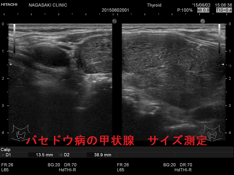 バセドウ病の甲状腺 サイズ測定(右垂直断) バセドウ病の甲状腺 サイズ測定(右垂直断)