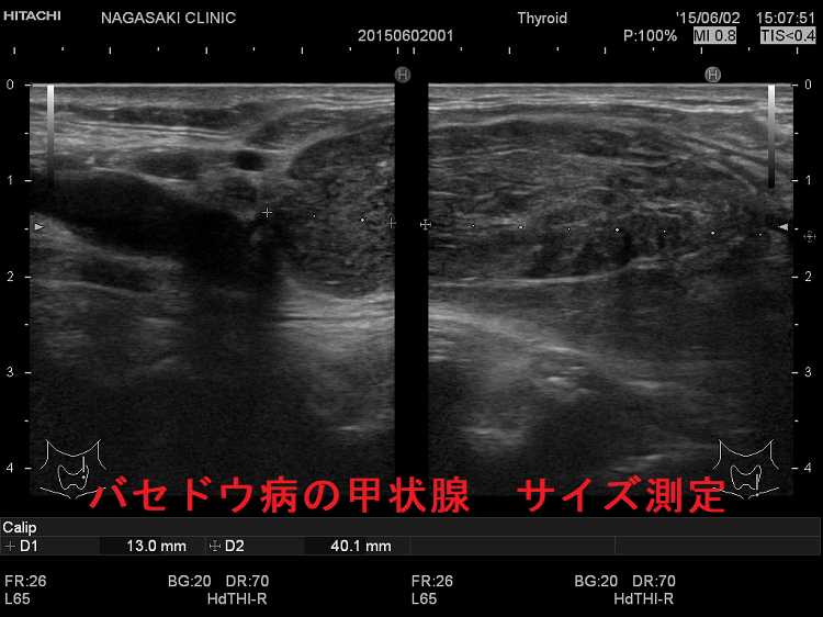 バセドウ病の甲状腺 サイズ測定(左垂直断) バセドウ病の甲状腺 サイズ測定(左垂直断)