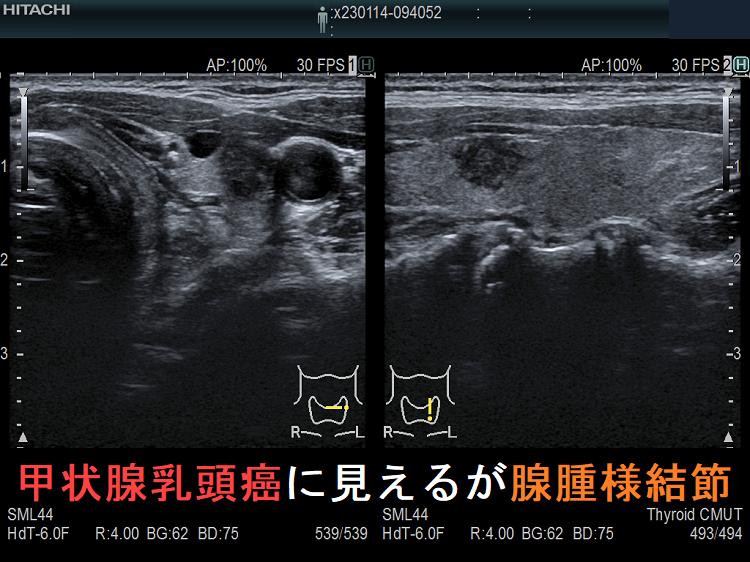 甲状腺乳頭癌に見えるが腺腫様結節 2-1 甲状腺乳頭癌に見えるが腺腫様結節 2-1