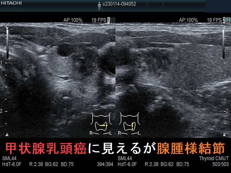 腺腫様結節(乳頭癌の様にも見える) 腺腫様結節(乳頭癌の様にも見える)