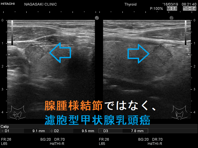 腺腫様結節ではなく濾胞型甲状腺乳頭癌 腺腫様結節ではなく濾胞型甲状腺乳頭癌