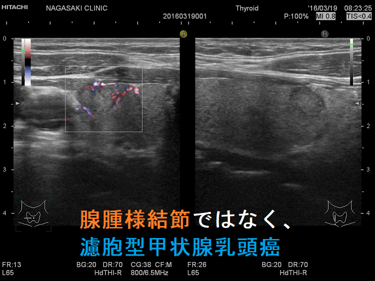 腺腫様結節ではなく濾胞型甲状腺乳頭癌 ドプラーモード 腺腫様結節ではなく濾胞型甲状腺乳頭癌 ドプラーモード