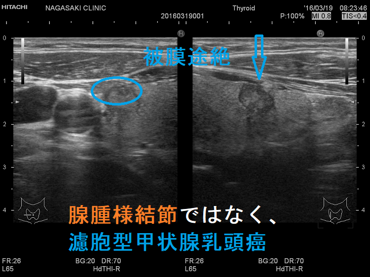腺腫様結節ではなく濾胞型甲状腺乳頭癌 超音波(エコー)画像 腺腫様結節ではなく濾胞型甲状腺乳頭癌 超音波(エコー)画像
