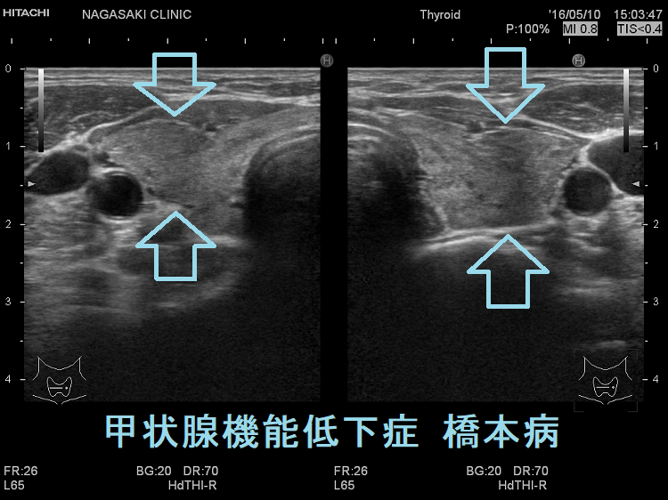 甲状腺機能低下症 橋本病 超音波(エコー)画像 甲状腺機能低下症 橋本病 超音波(エコー)画像