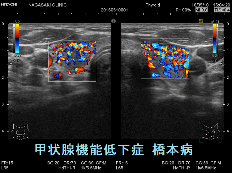 甲状腺機能低下症 橋本病 超音波(エコー)画像 ドプラーモード 甲状腺機能低下症 橋本病 超音波(エコー)画像 ドプラーモード