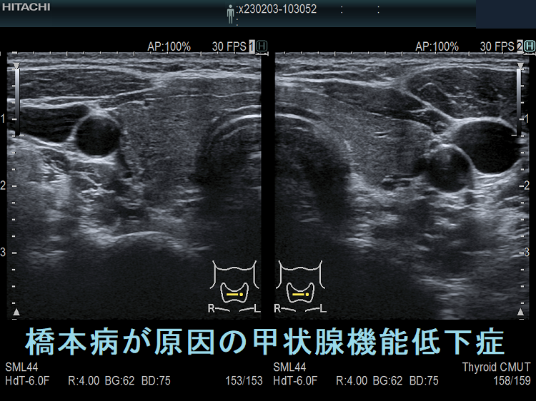 橋本病が原因の甲状腺機能低下症 超音波(エコー)画像 橋本病が原因の甲状腺機能低下症 超音波(エコー)画像